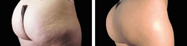 Buttocks area before and after Emsculpt NEO results.