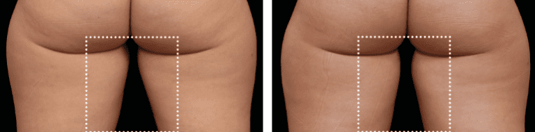 Buttocks and thighs area before and after Emsculpt NEO results.