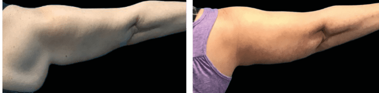 Under arm area before and after Emsculpt NEO results.