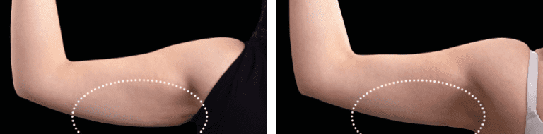 Under arm area before and after Emsculpt NEO results.