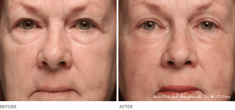 Woman's results before and after Morpheus8 RF Microneedling.