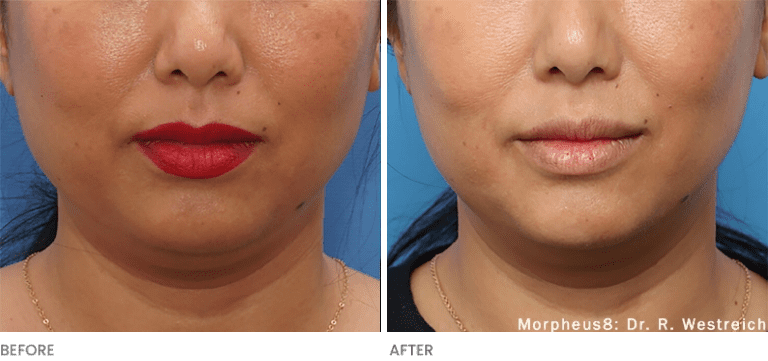 Woman's results before and after Morpheus8 RF Microneedling.