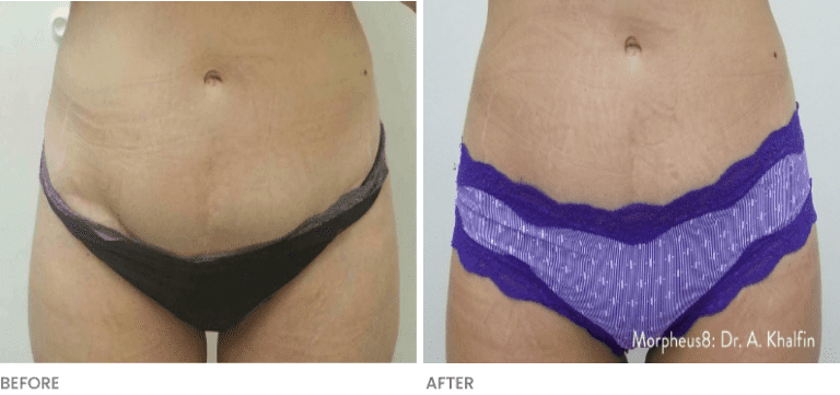 Abdomen showing results before and after Morpheus8 RF Microneedling.