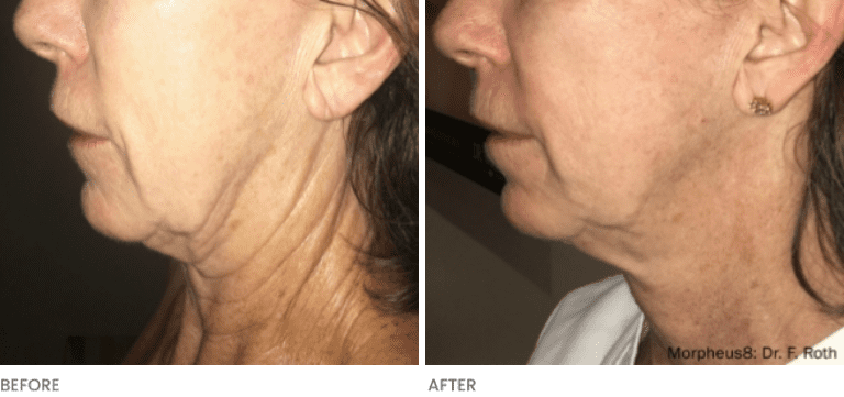 Side profile of chin showing results before and after Morpheus8 RF Microneedling.