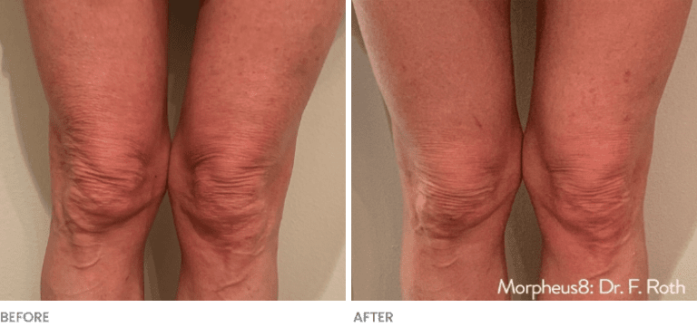 Knee area showing results before and after Morpheus8 RF Microneedling.