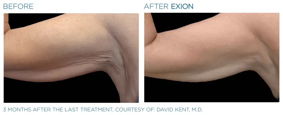 Exion Body Before and Afters