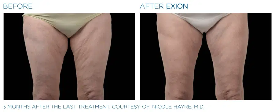 Exion Body Before and Afters