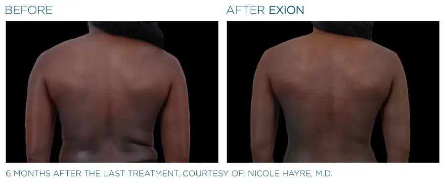 Exion Body Before and Afters