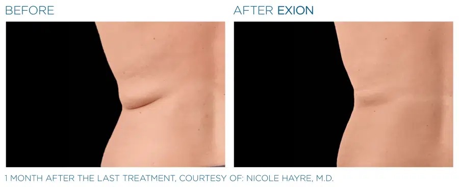 Exion Body Before and Afters