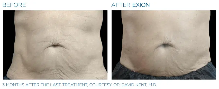 Exion Body Before and Afters