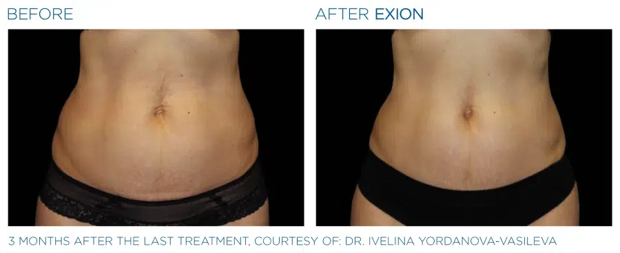 Exion Body Before and Afters