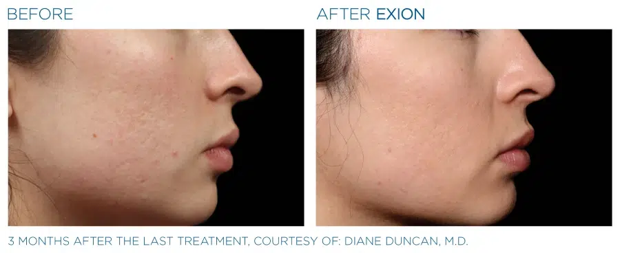 Exion Microneedling Before and Afters