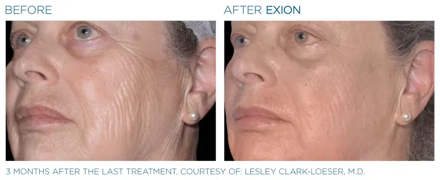 Exion Microneedling Before and Afters