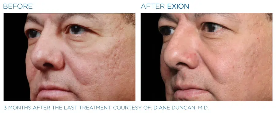 Exion Microneedling Before and Afters