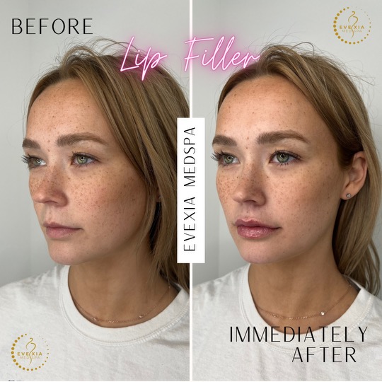 Before and after results from dermal fillers.