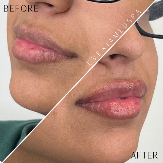 Before and after results from dermal fillers.