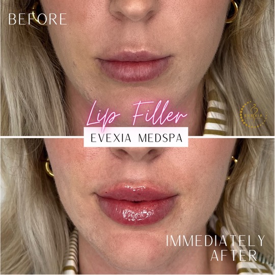 Before and after results from dermal fillers.