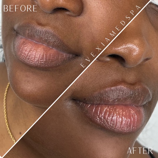 Before and after results from dermal fillers.