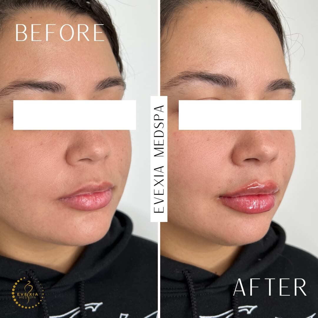 Before and after results from dermal fillers.