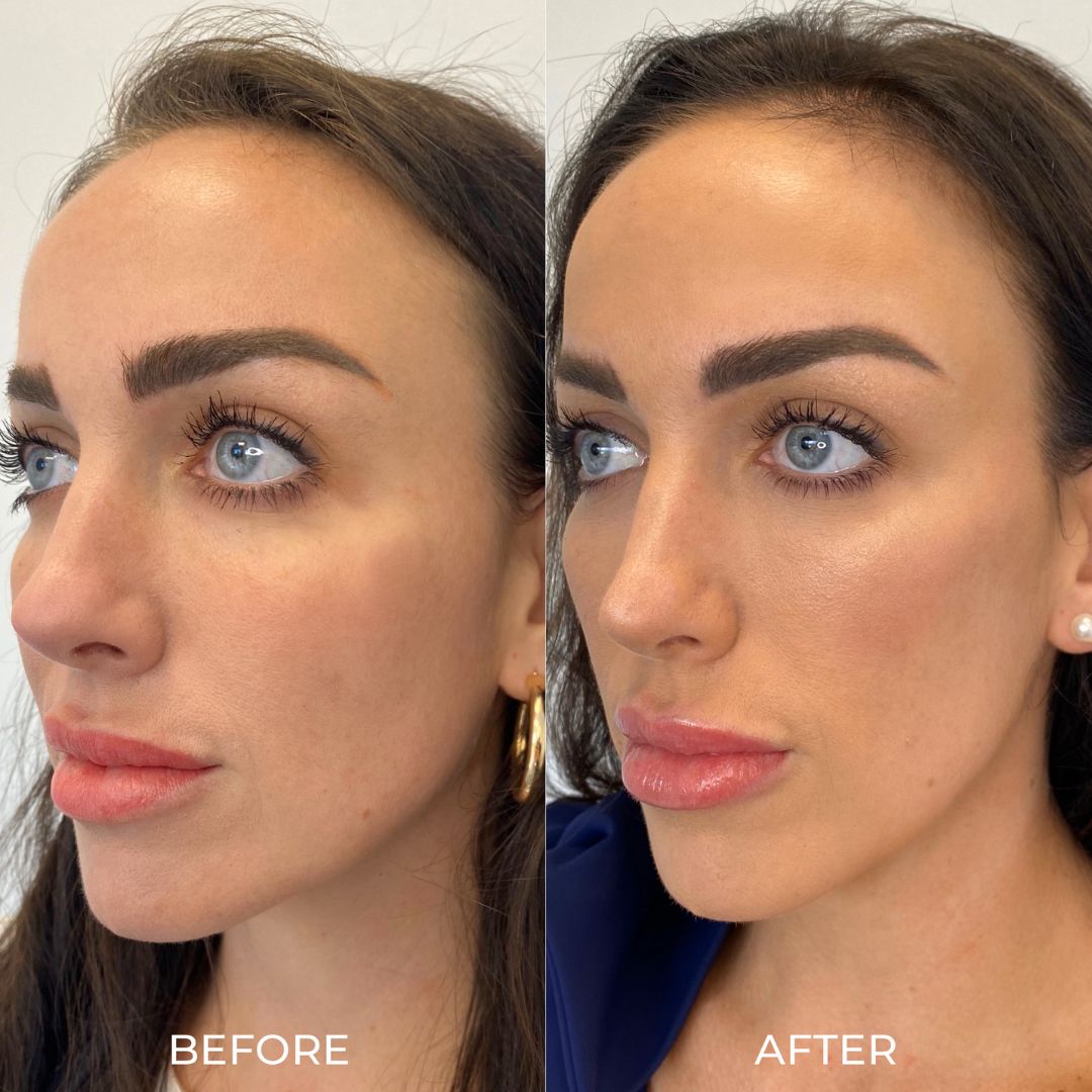 Before and after results from dermal fillers.