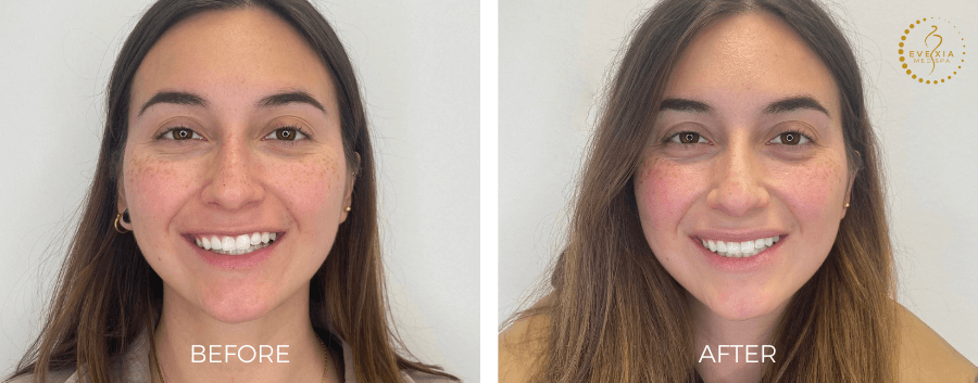 Before and after results from dermal fillers.