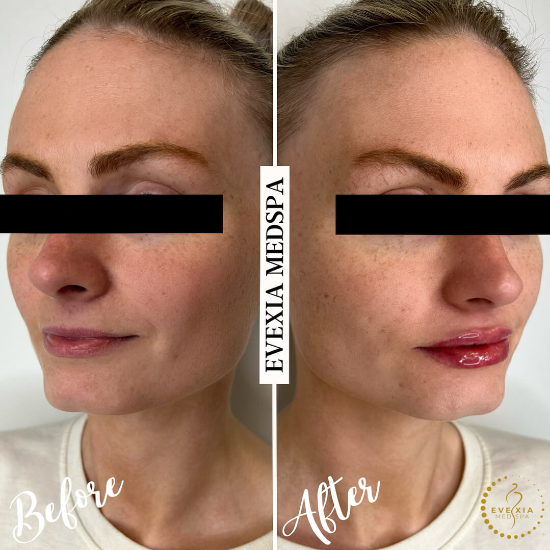 Before and after results from dermal fillers.